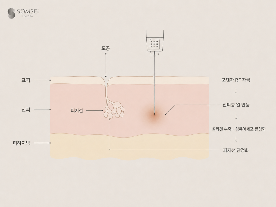 바늘이 닿는 깊이에서 열이 만들어지고, 표면은 지나갑니다.