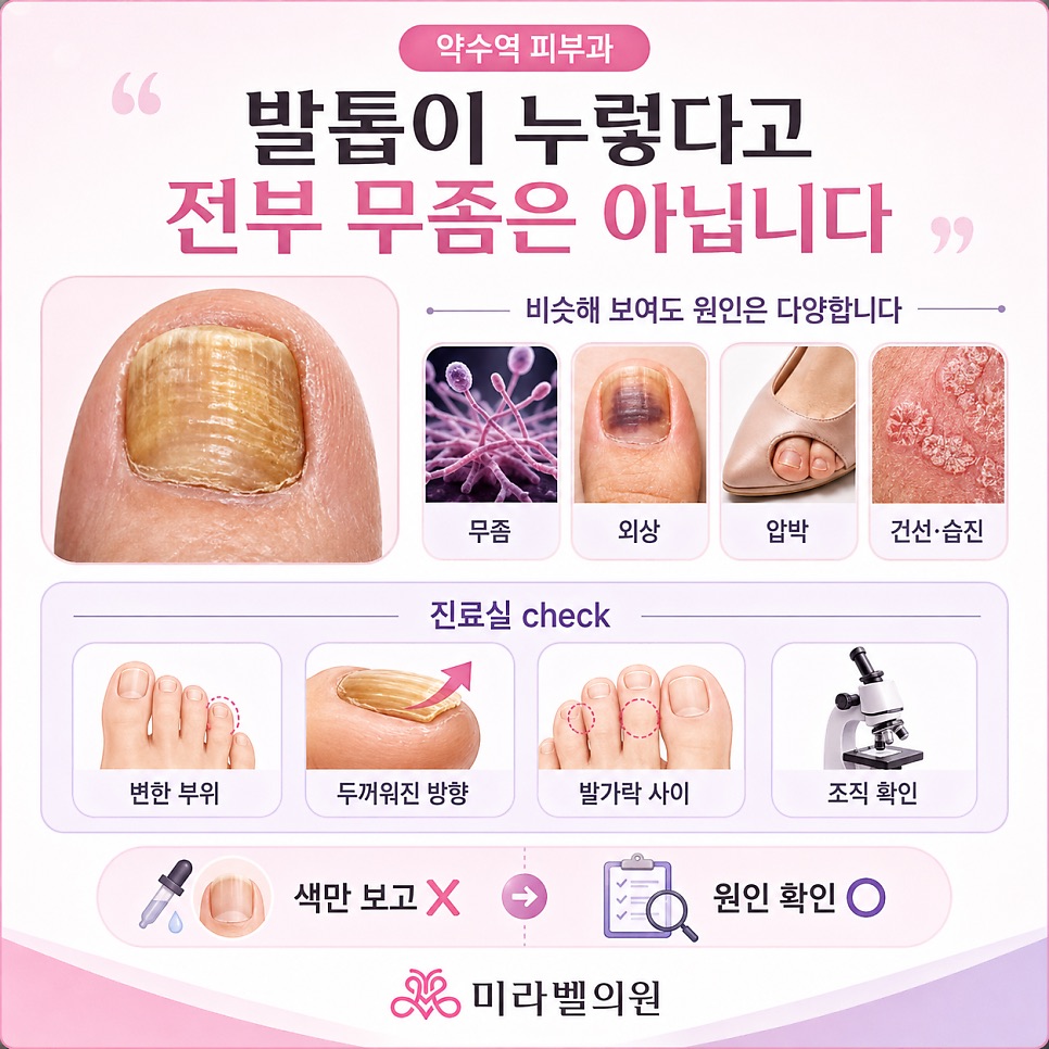 발톱무좀 약 먹었는데 왜 또 생기나요? (약수역 피부과)