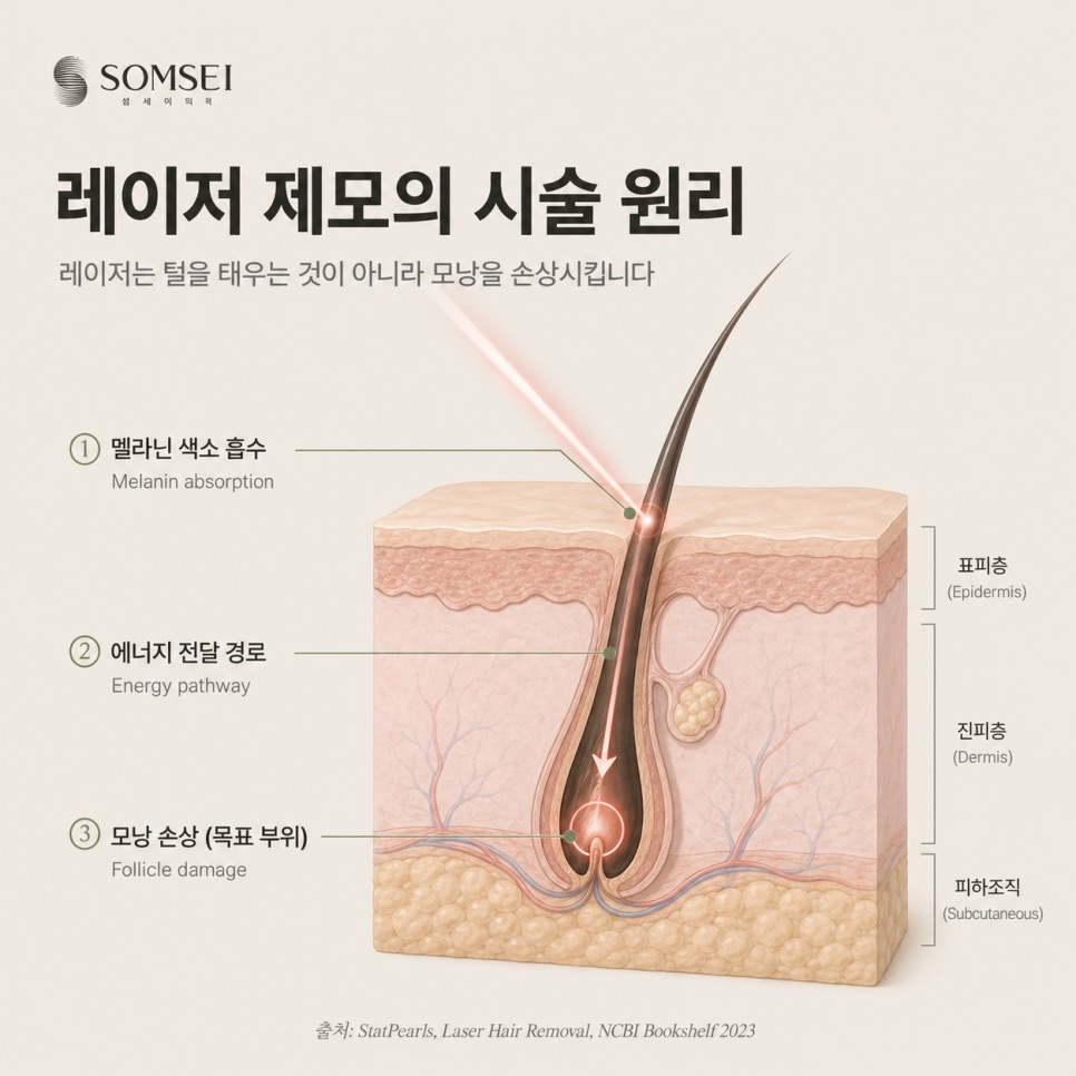 참고 내용 출처: StatPearls, Laser Hair Removal, NCBI Bookshelf 2023