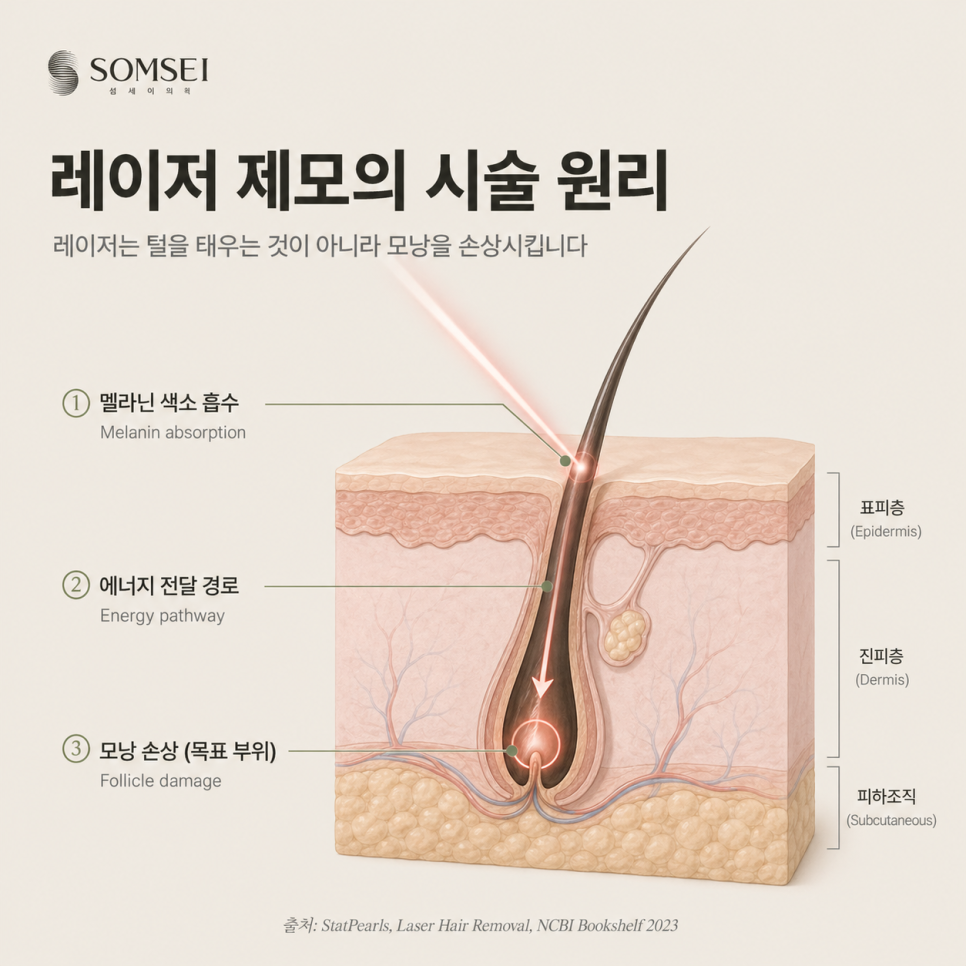 참고 내용 출처: StatPearls, Laser Hair Removal, NCBI Bookshelf 2023