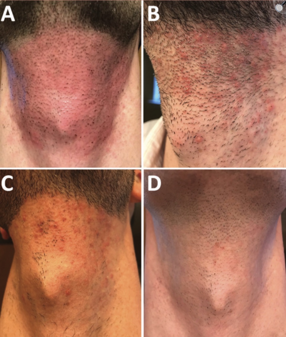 출처: Dierickx et al., Journal of Clinical and Aesthetic Dermatology, 2020 (PMC7380697)