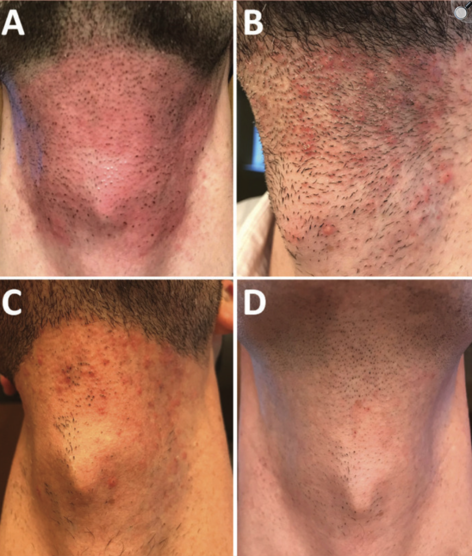 출처: Dierickx et al., Journal of Clinical and Aesthetic Dermatology, 2020 (PMC7380697)