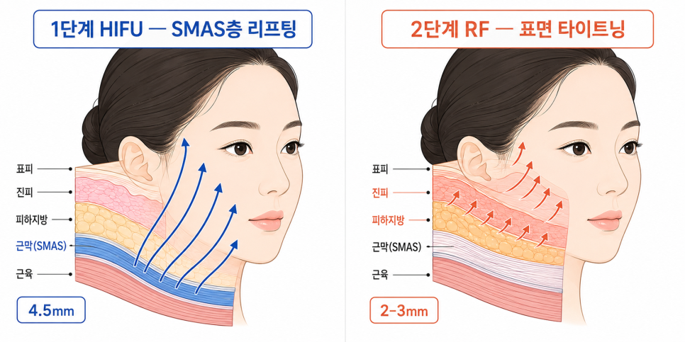 HIFU 와 RF 의 치료