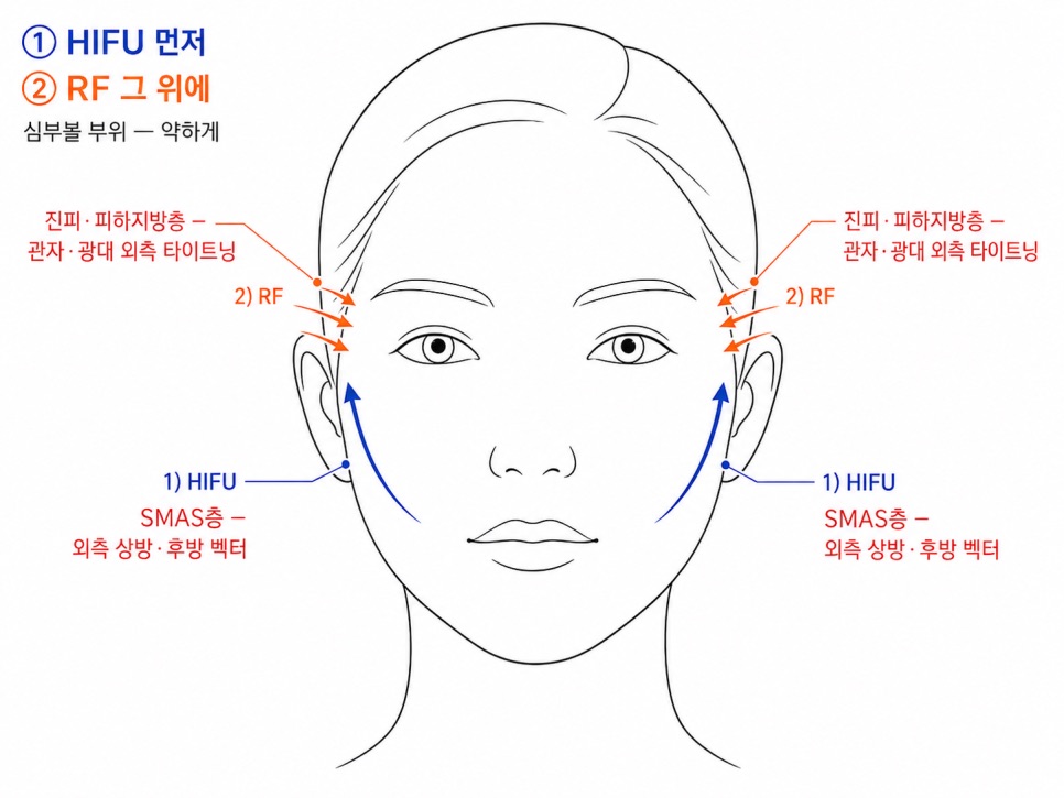 그래서 시술 순서와 벡터 방향이 중요합니다
