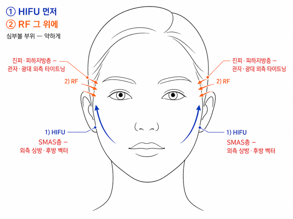 그래서 시술 순서와 벡터 방향이 중요합니다