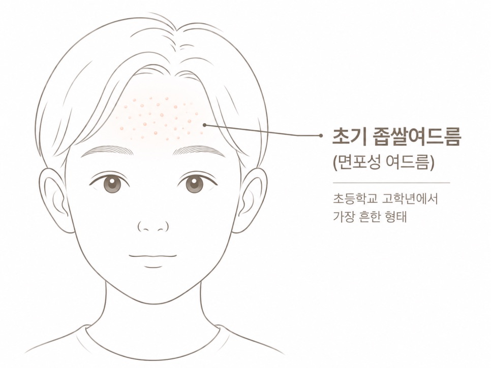 초등학생 좁쌀여드름, 어떤 약을 쓸 수 있나요 (강동구 소아여드름)