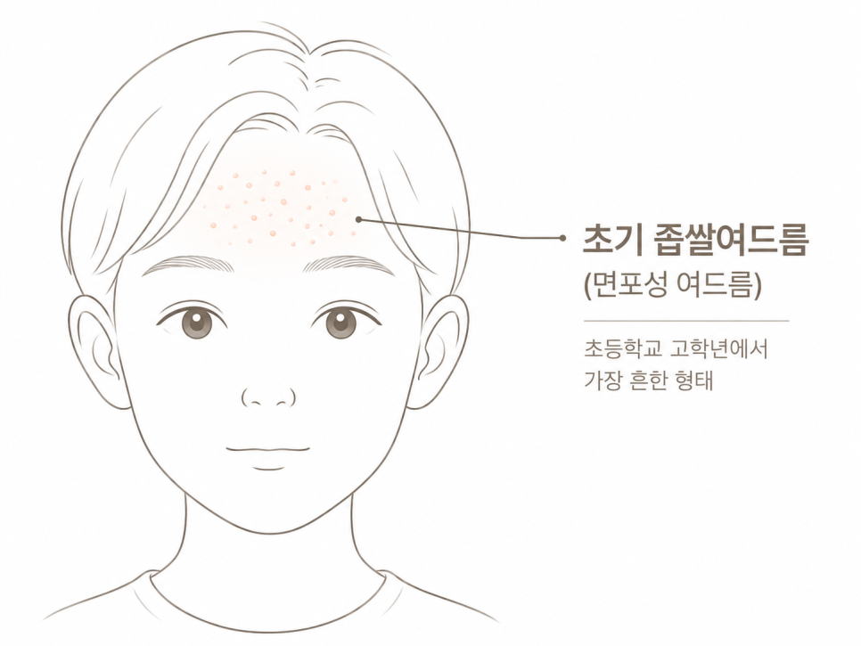 초등학생 이마 좁쌀여드름, 어떤 약을 쓸 수 있을까요?