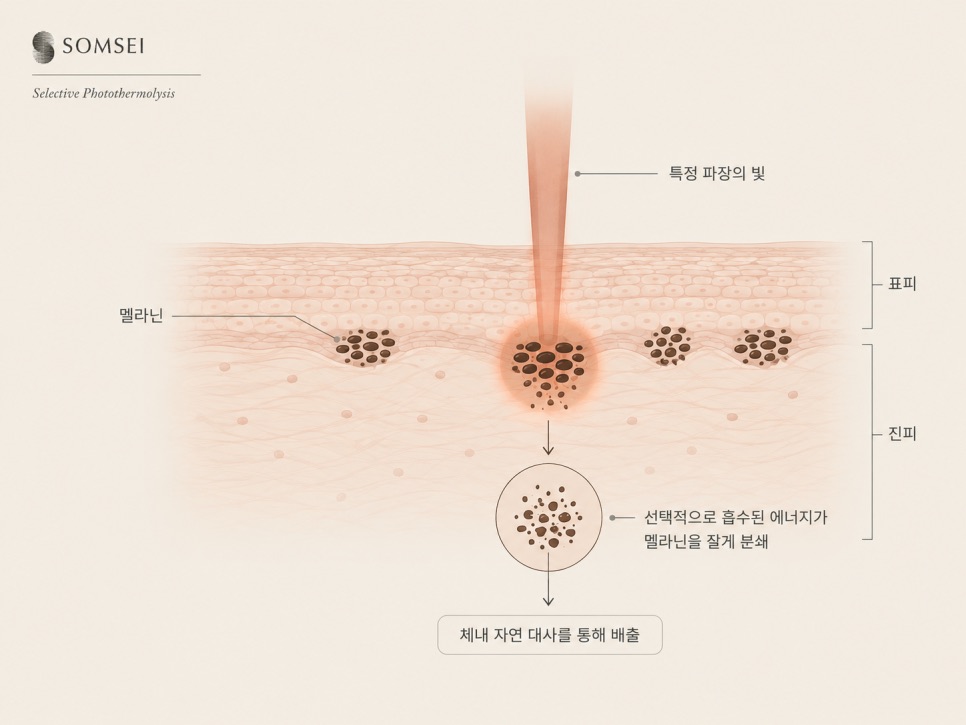 "여름에는 색소레이저 하면 안 되나요?"